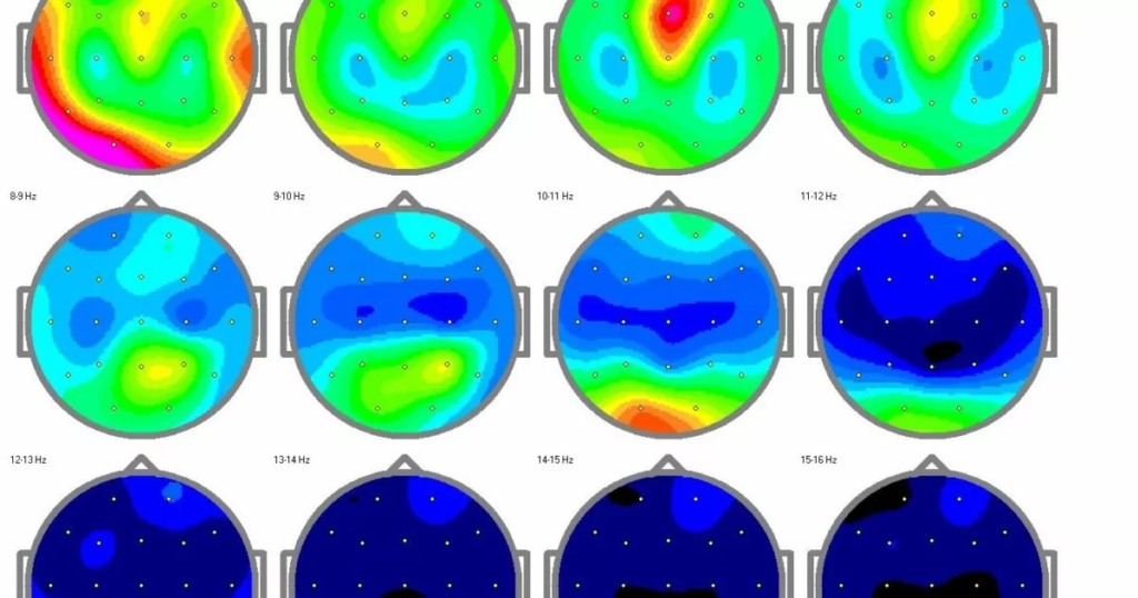 Badanie QEEG to zaawansowana metoda analizy aktywności elektrycznej mózgu